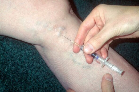 skleroterapia żylaków