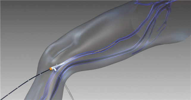 Obliteracja żylaków za pomocą fal radiowych