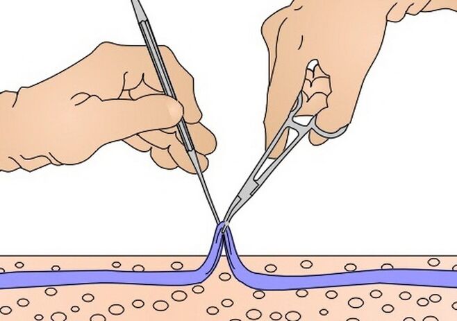 usuwanie żylaków na żylaki
